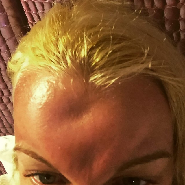 Collect of Katie Byrne after using the cream, Cancun. A stunning blonde had her dream holiday ruined after a rare allergic reaction to a posh cream left her entire face swollen - and looking like a BEETROOT. See SWNS story SWCREAM; Katie Byrne says her dream holiday was ruined after her face swelled to almost twice normal size and broke out in huge red sores and dents, moments after she applied the Ã30 face cream.  Normally-beautiful Katie, 26, was given steroid injections to calm the severe allergic reaction by hotel doctors, but she was left looking red-faced for the rest of her ten-day trip to Mexico.  The personal assistant, from Dagenham, Essex, had treated herself to the Ã30 Clarins beauty cream on her flight from Heathrow, as she jetted off to the tropical resort of Hard Rock Cancun with boyfriend Connor.  She used the 'Beauty Flash Balm' on the second day of her luxury Ã2,000 holiday, and was horrified when the expensive cream left her feeling like her face was on fire.  Katie said: "When I realised how red my face was I couldn't believe it, I looked like a tomato.  I tried to go to bed and forget about it but I woke up in the middle of the night  screaming in pain.  When I looked in the mirror I saw huge dents in my forehead and I was terrified my face was caving in.  My skin was stinging so much I had to call a doctor."