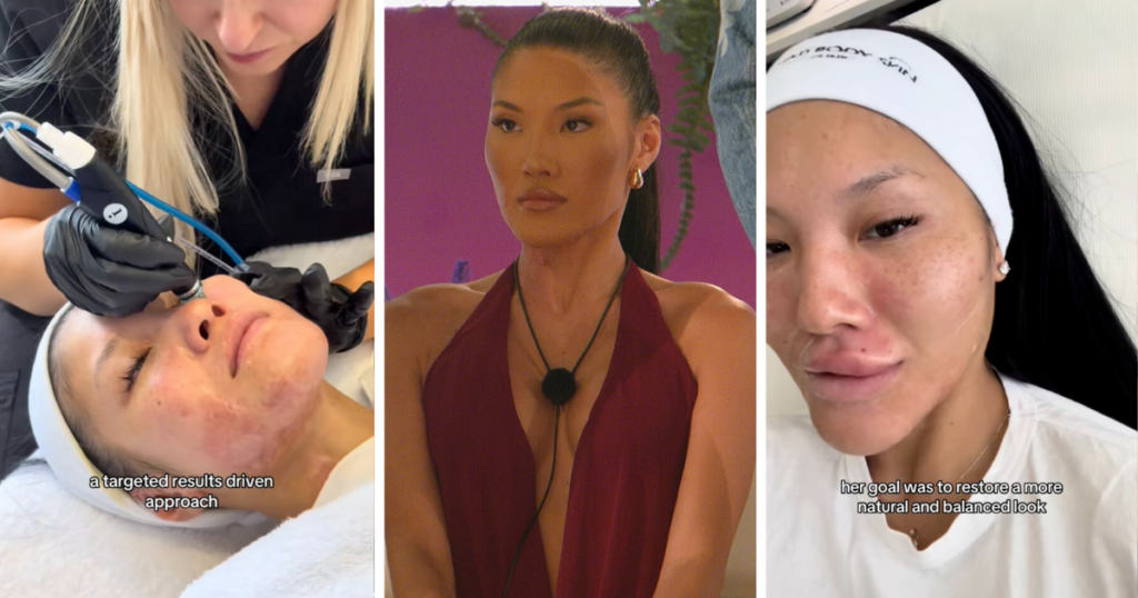 Sophie Lee had cosmetic work for Love Island 2025