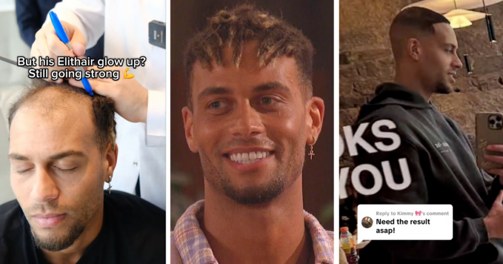 Love Island Ouzy hair transplant