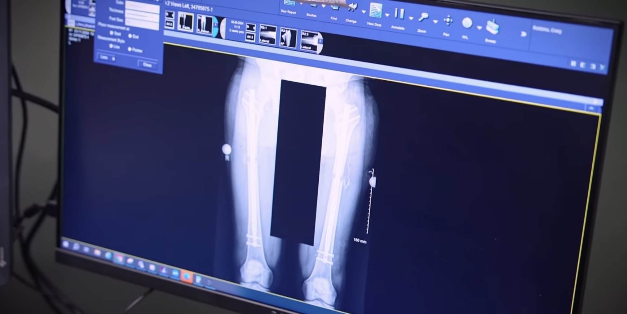 An X-ray screening of a man's legs before cosmetic leg lengthening surgery