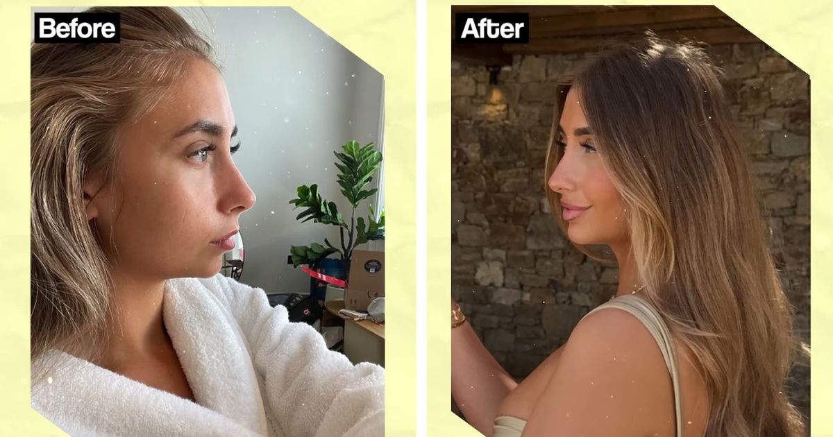 lily phillips chin cosmetic surgery before and after