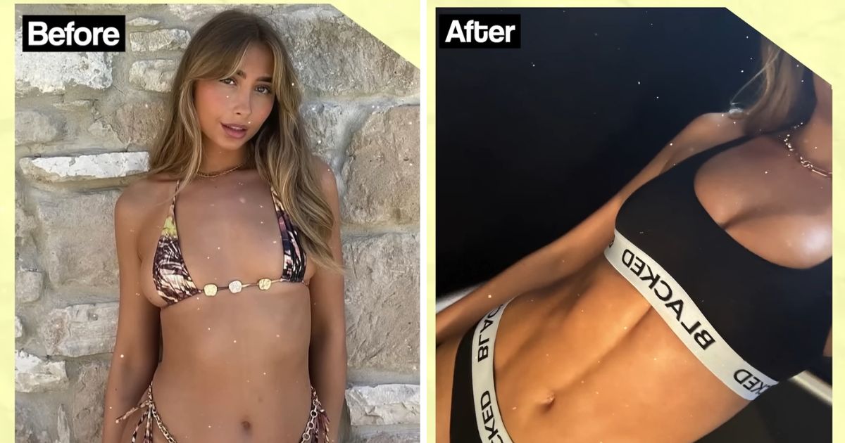 lily phillips liposuction before and after