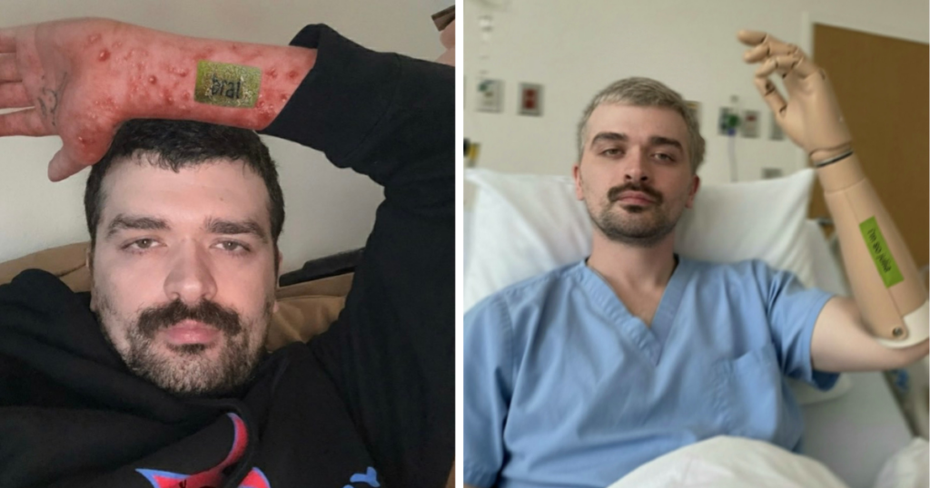 brat tattoo infection