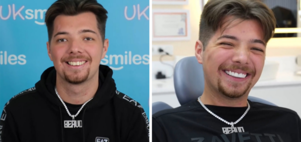 Beavo teeth before and after