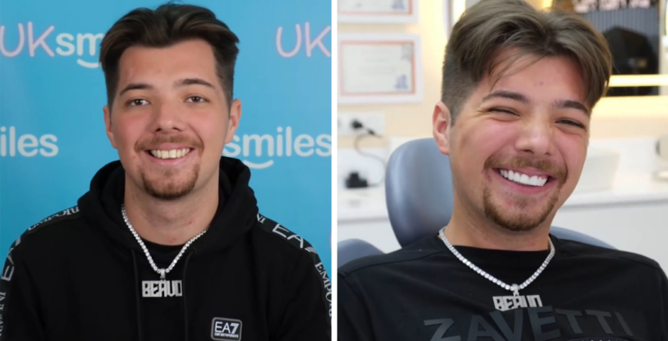 Beavo teeth before and after