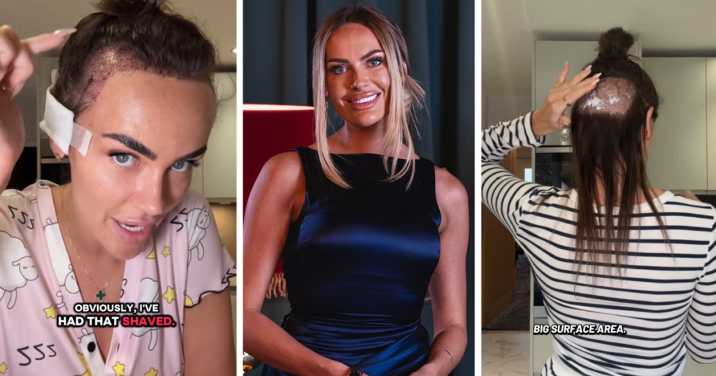 Amy from MAFS UK has had a hair transplant