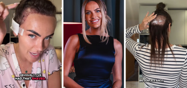 Amy from MAFS UK has had a hair transplant