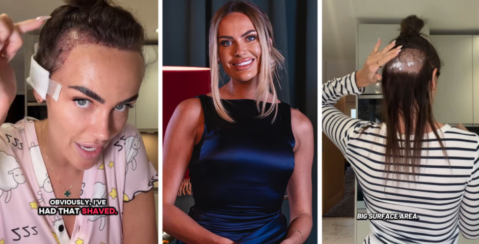 Amy from MAFS UK has had a hair transplant